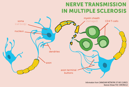 Multiple sclerosis attacks nerves